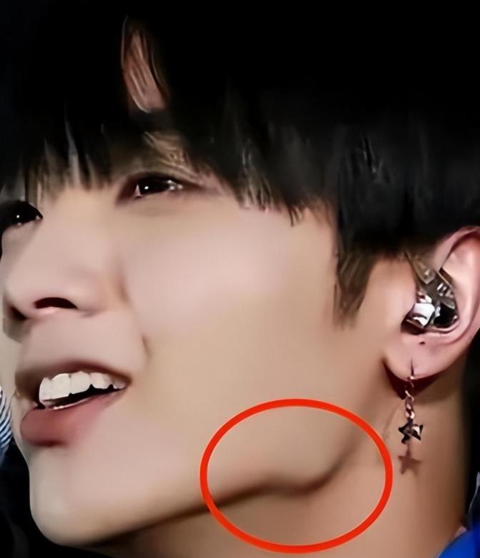 怎么不整容就能成为小v脸,不用整容也能变v脸吗