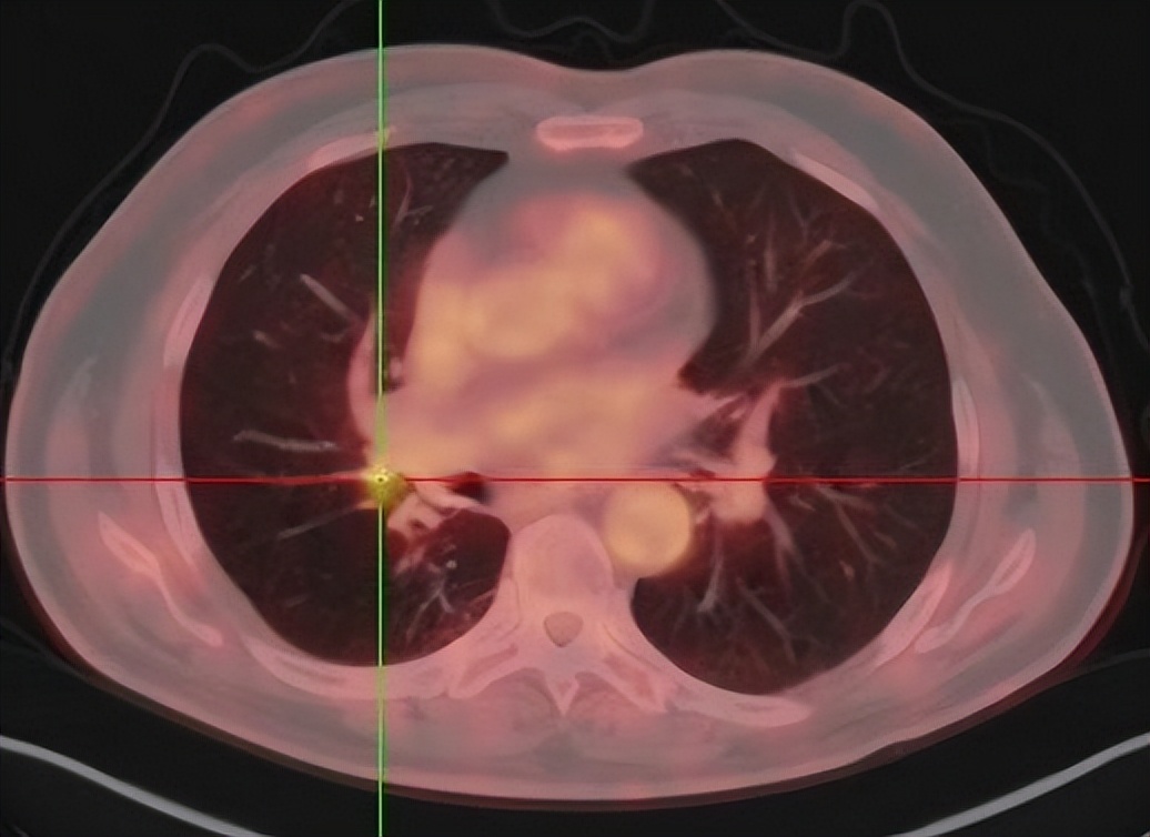 肺癌术后复发胸膜转移,肺癌术后复发转移还需要治疗吗