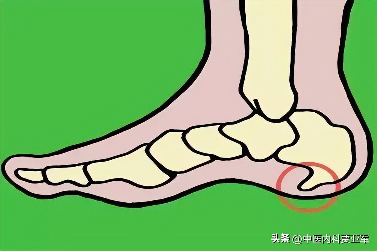 足跟骨刺的最佳治疗办法药方,骨刺足跟痛偏方最快最有效的