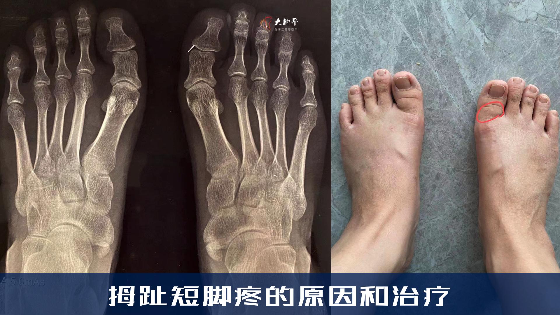 大拇趾短怎么办？脚拇趾太短了可以手术吗？