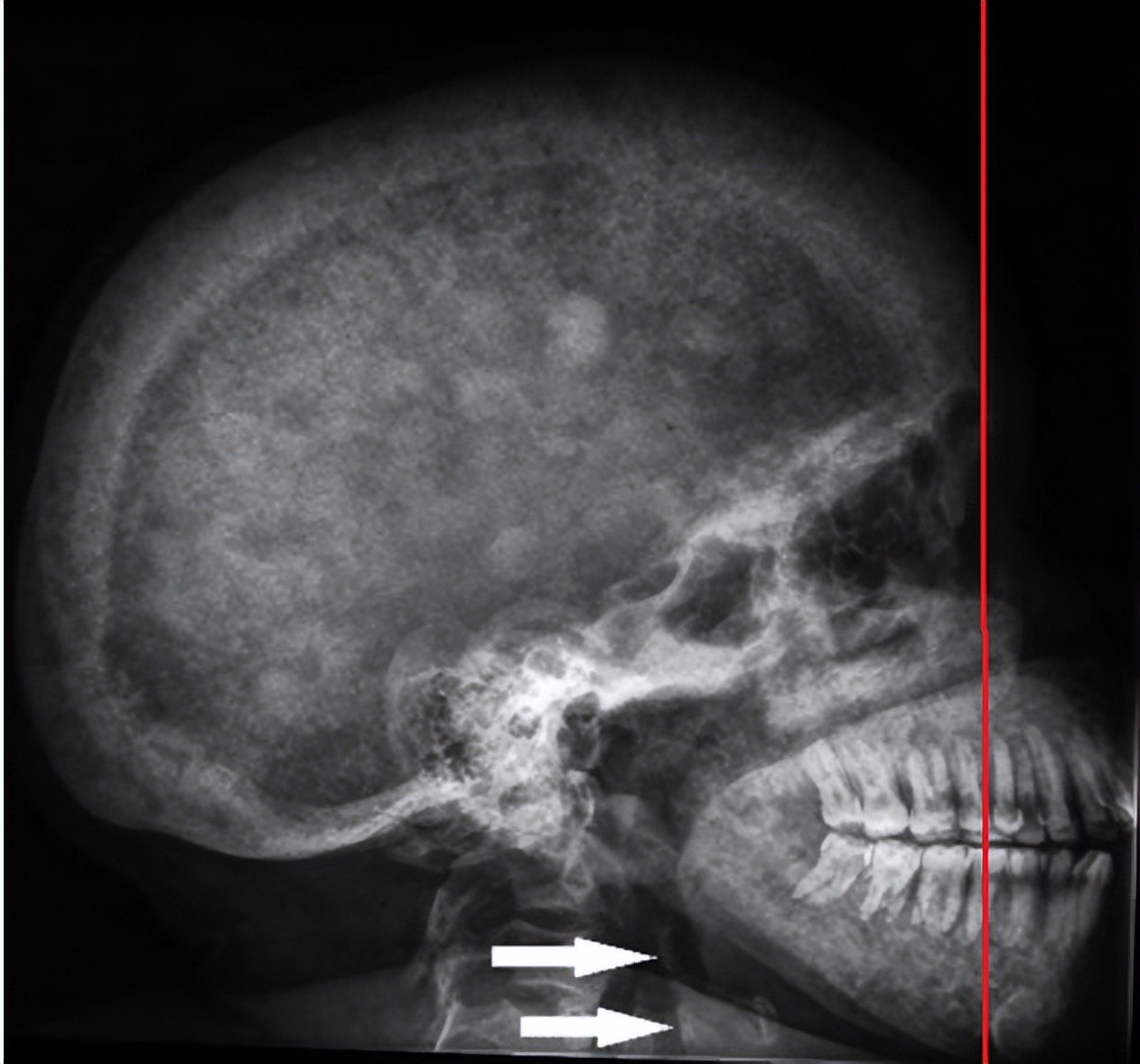 别的指标正常就是肌酐高怎么回事,这项指标升高需警惕前列腺癌