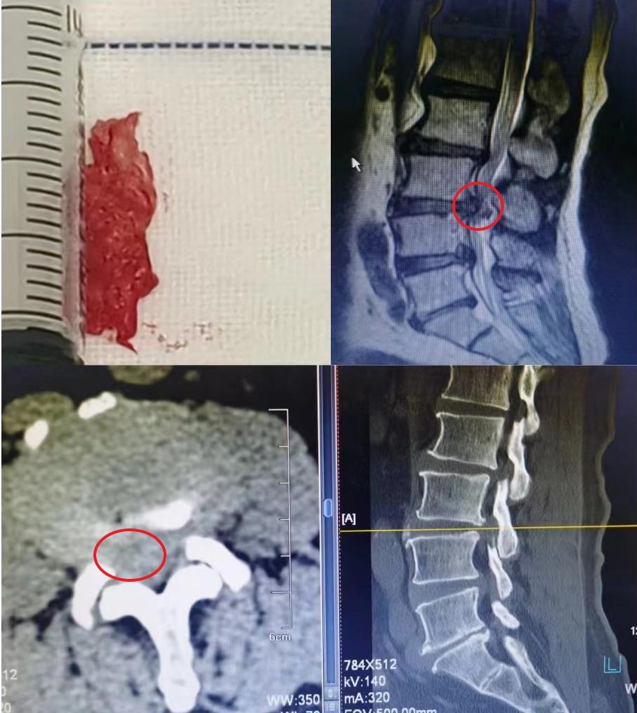 马尾神经受损患者,马尾神经受损治疗费用
