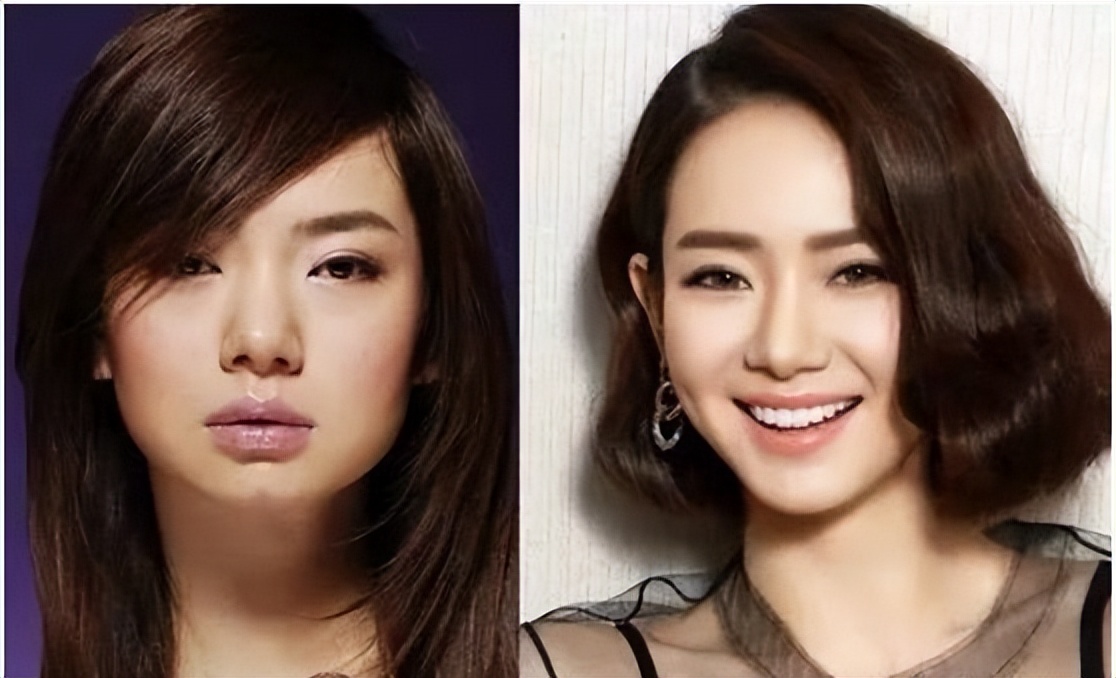 下巴后缩要怎么整形,下巴后缩做什么手术矫正