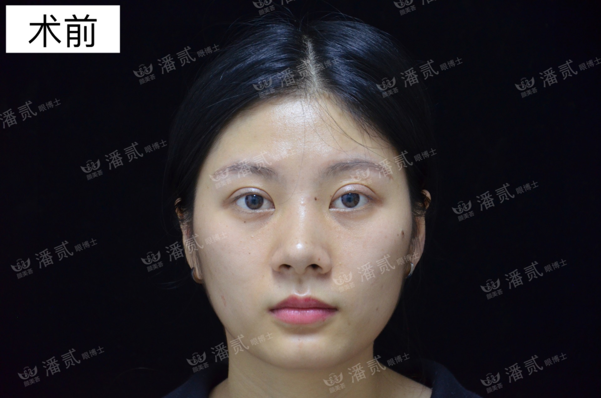 双眼皮贴导致眼皮破了,双眼皮贴导致眼皮严重下垂恢复