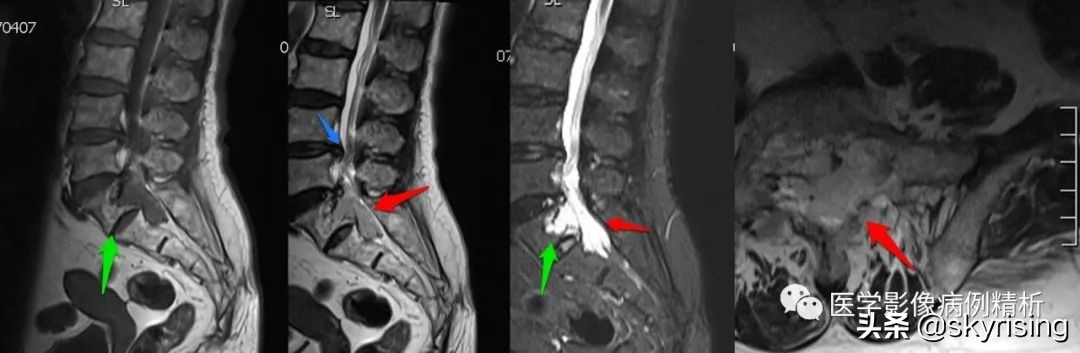 老年女性骶骨受侵椎管骶管内富血供占位影诊思维过程