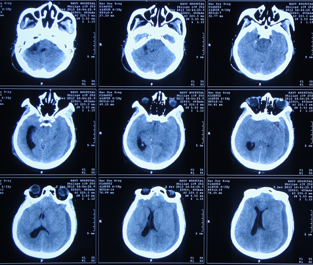 听神经瘤出现脑积水和出血,听神经瘤手术后颅压高症状