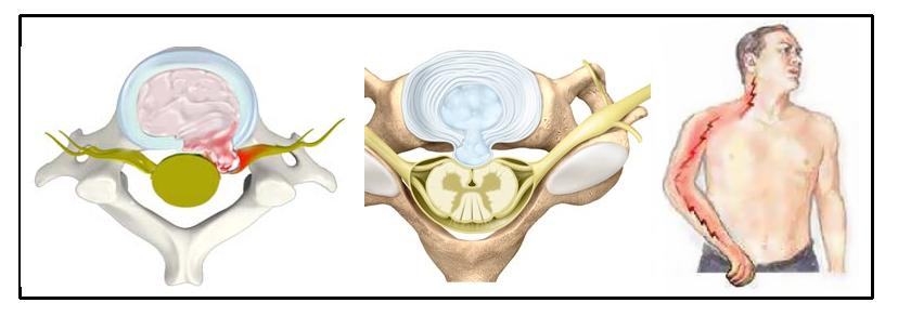 颈痛的最佳治疗方法,最近肩颈疼是什么病毒