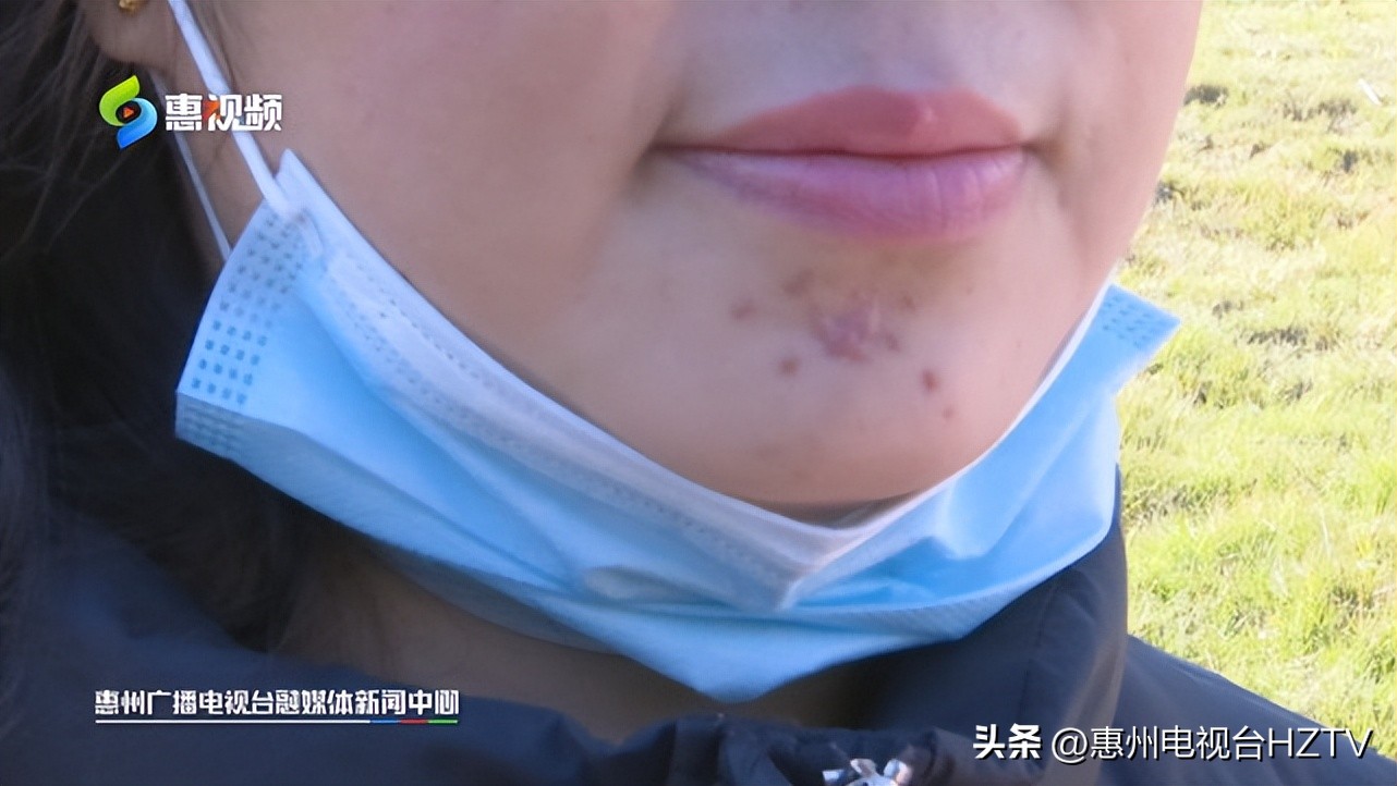 小伙在美容美发店治扁平疣,美容院点扁平疣会不会留疤