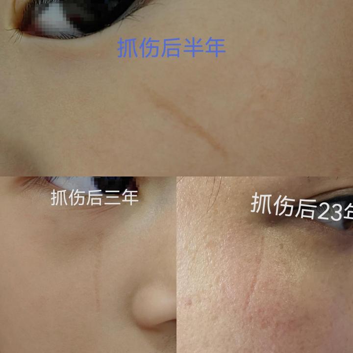 伤口做点阵激光治疗,点阵激光后怎么清理伤口