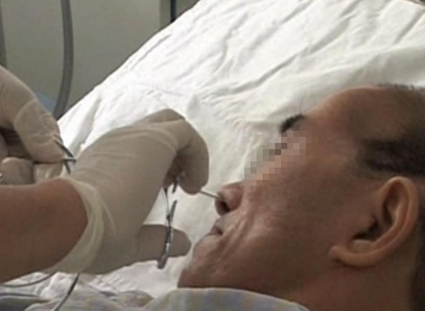 临终老人被强行抢救,癌症晚期昏迷插胃管