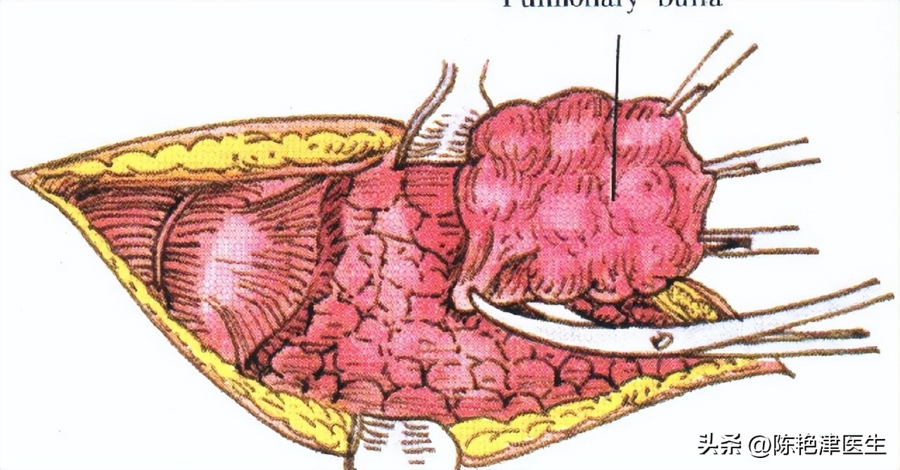 为什么医生不肯说肺大泡有多大,体检肺大疱是什么意思