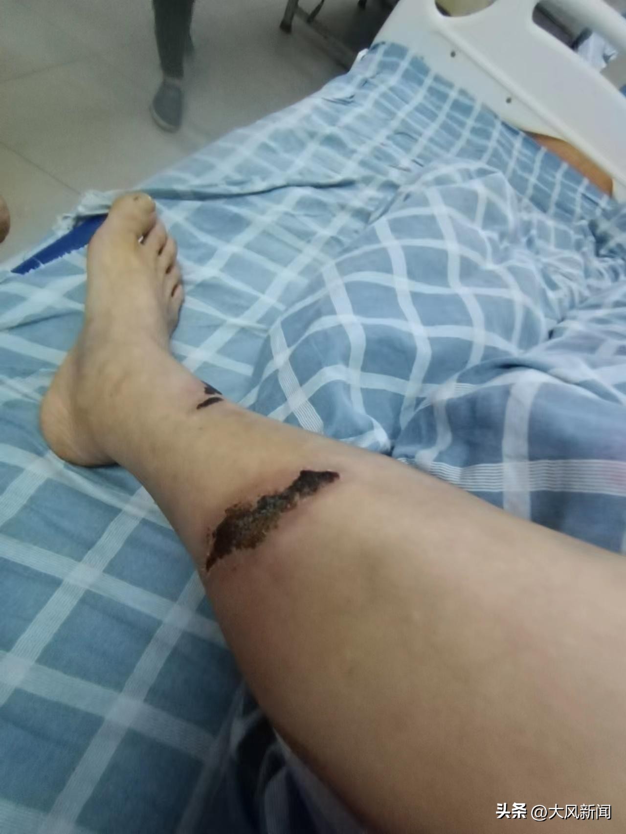 女员工被车撞伤后续,工厂内被同事叉车撞伤需要报警么