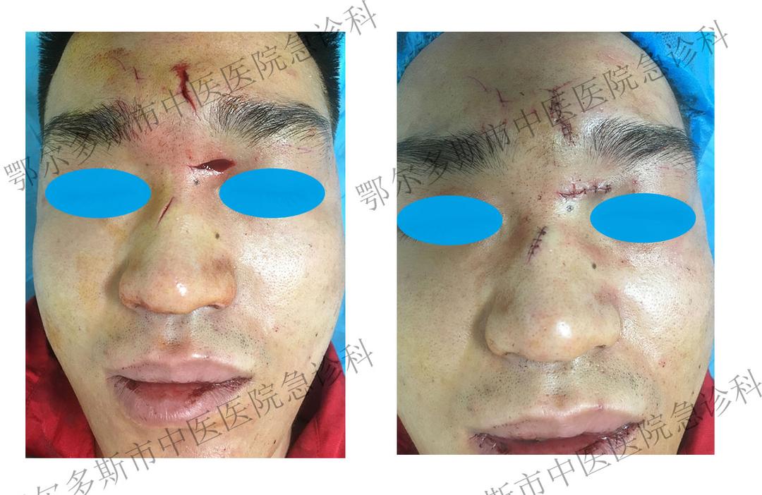 鄂尔多斯市中医医院急诊科,急诊科美容缝合后护理