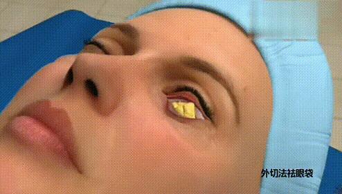 眼袋和卧蚕的区别看完你就知,怎么分清眼袋和卧蚕的区别图片