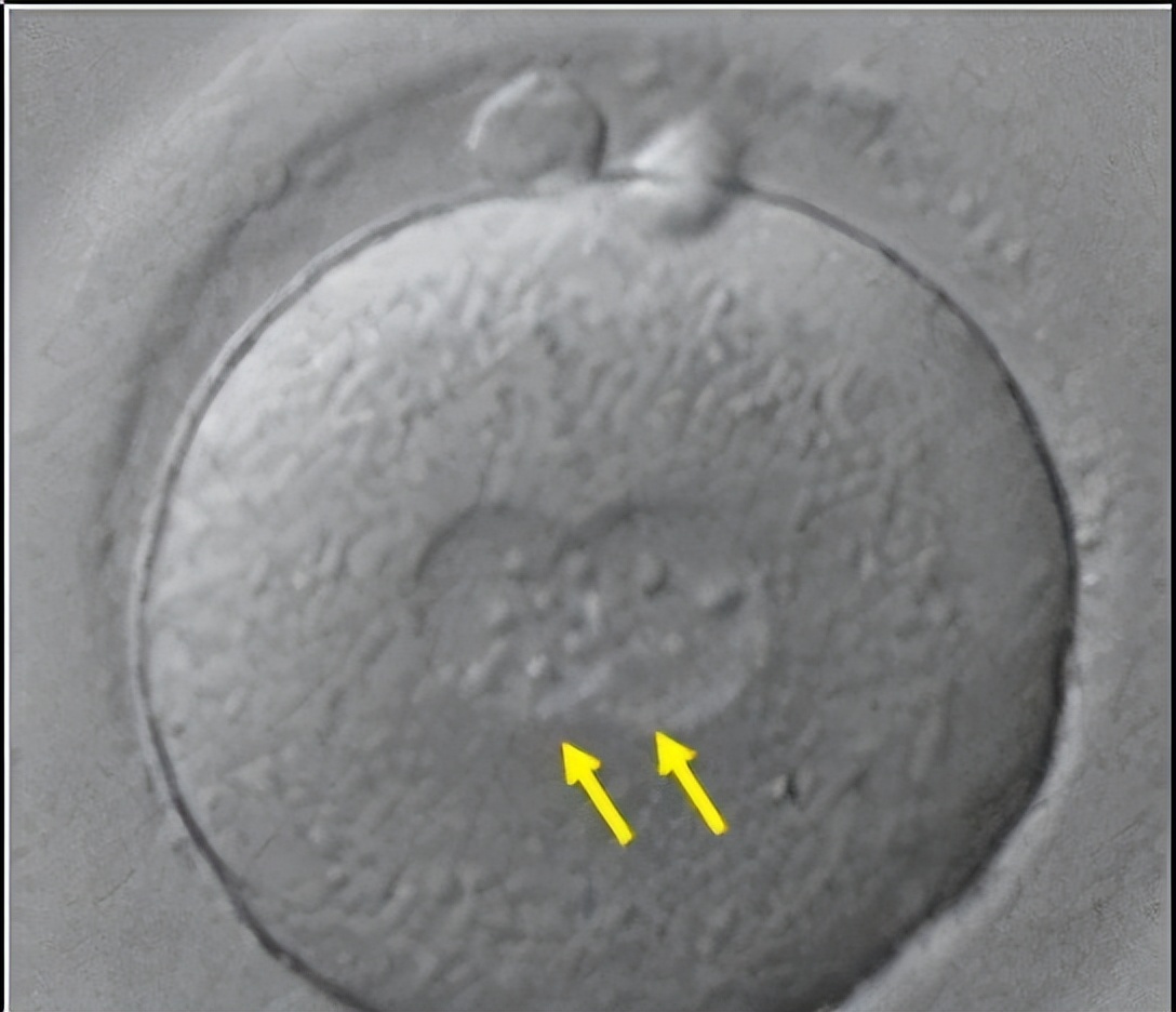 试管囊胚二十天着床动态图,试管婴儿囊胚移植第六天测白板