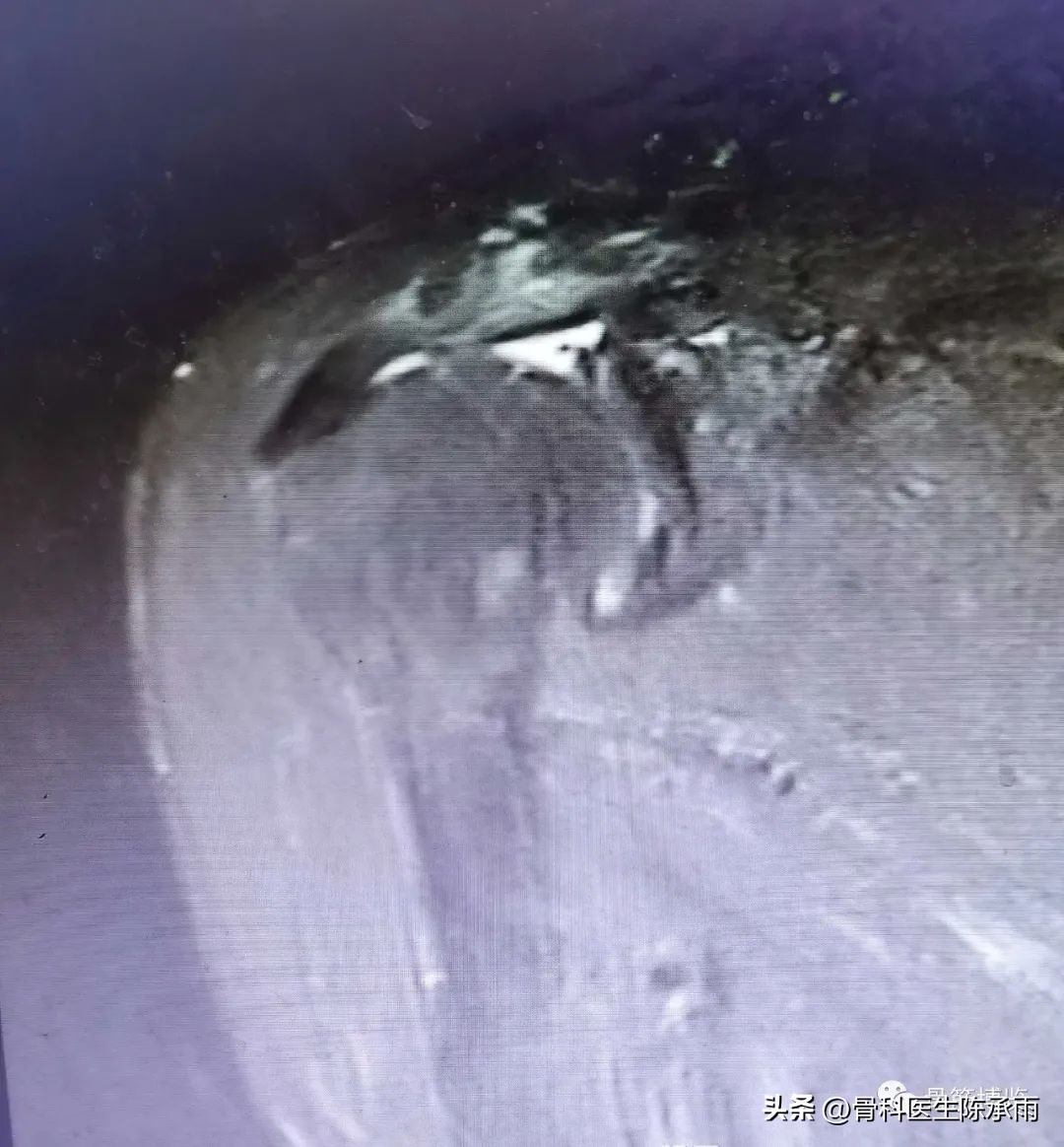 肱二头肌长头肌腱断裂超声报告,上臂肱二头肌