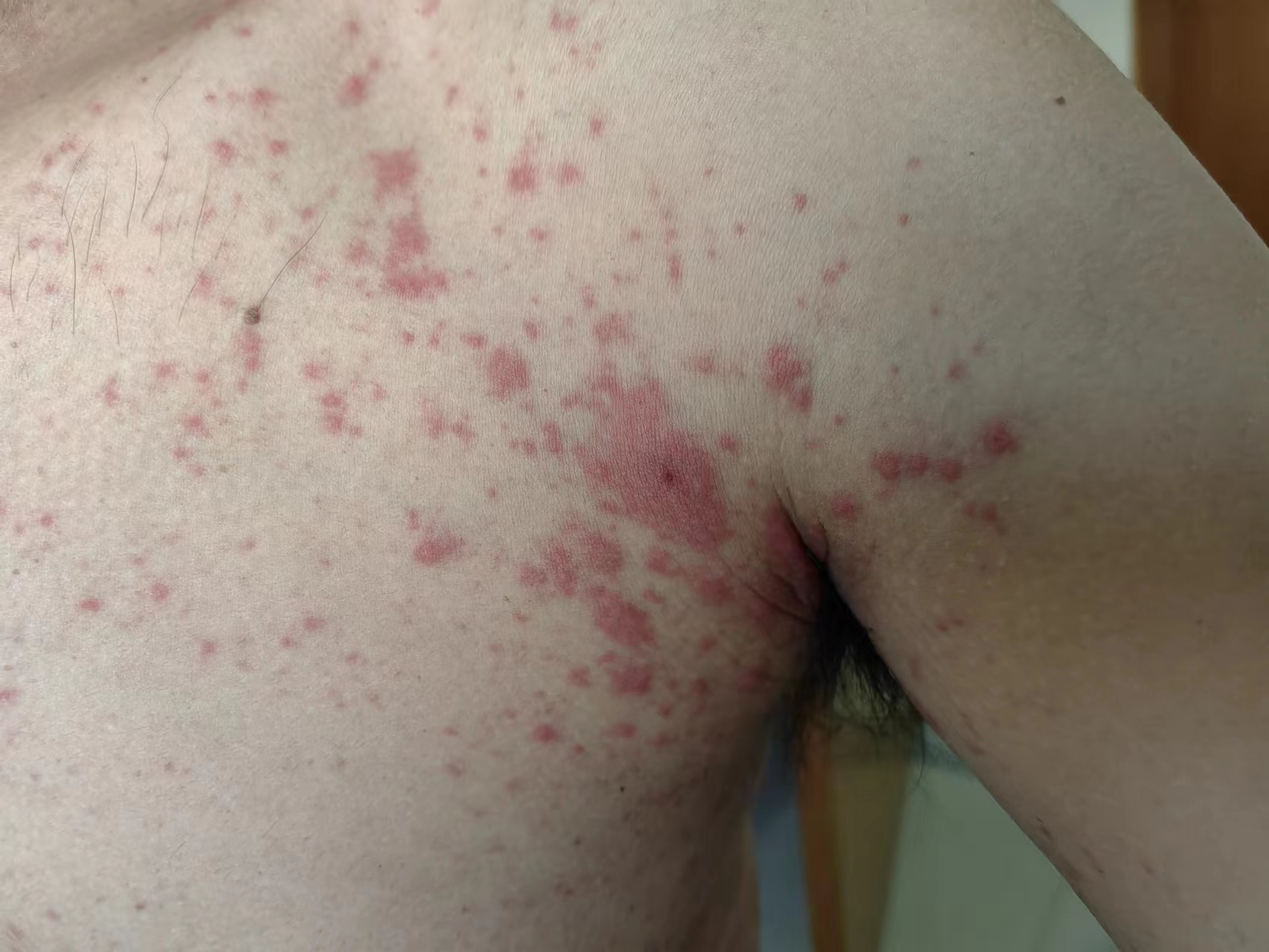 对镍过敏是怎么回事,镍过敏的人多不多