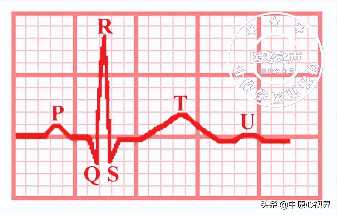 护考几种常见的心电图,常见的心电图图形分析