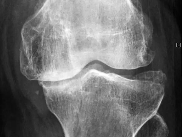 氨糖到底有没有效果,氨糖到底是噱头还是真的有用