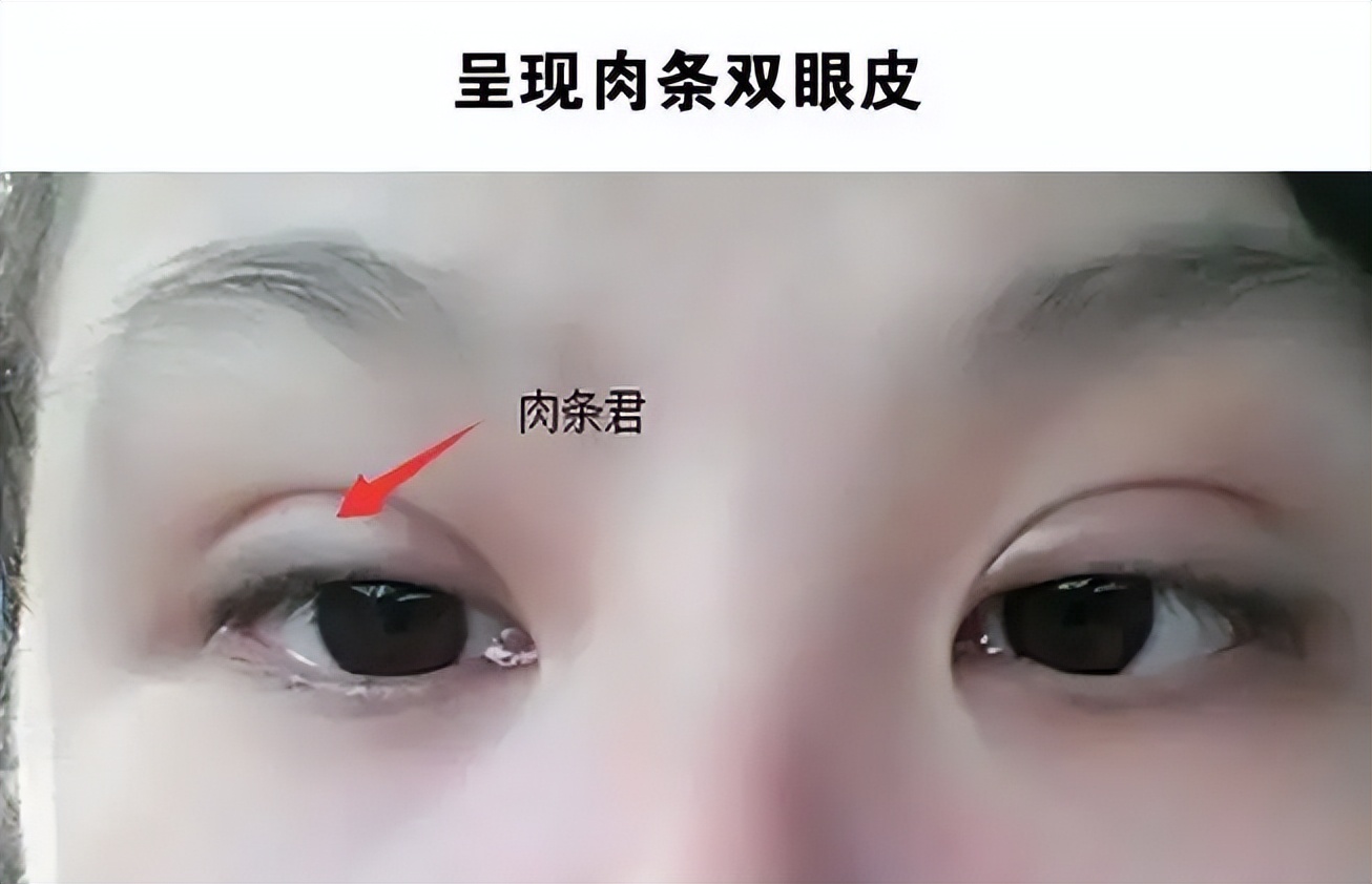 双眼皮修复宽改窄有肉条感,全切双眼皮出现肉条可以修复吗