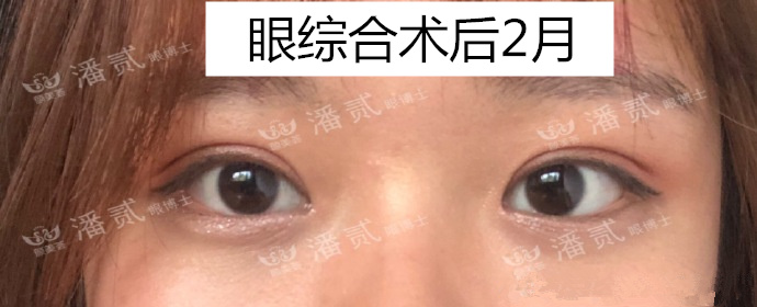 割过双眼皮的人有什么特征,割过双眼皮的真实感受