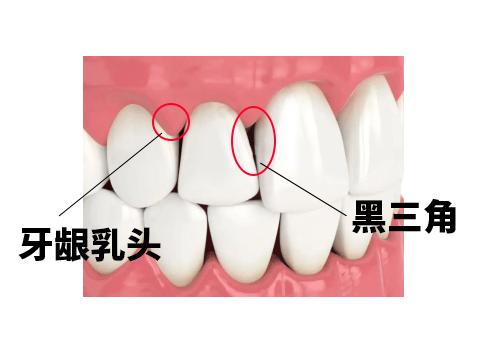 蛀牙引起的黑三角怎么治,牙齿黑三角处蛀牙怎么办