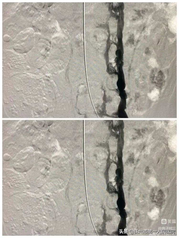 布加氏综合征介入治疗的注意事项,布加综合征介入手术加支架的利弊
