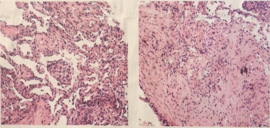 劳累引起发烧反复,劳累后发热属于气虚发热么