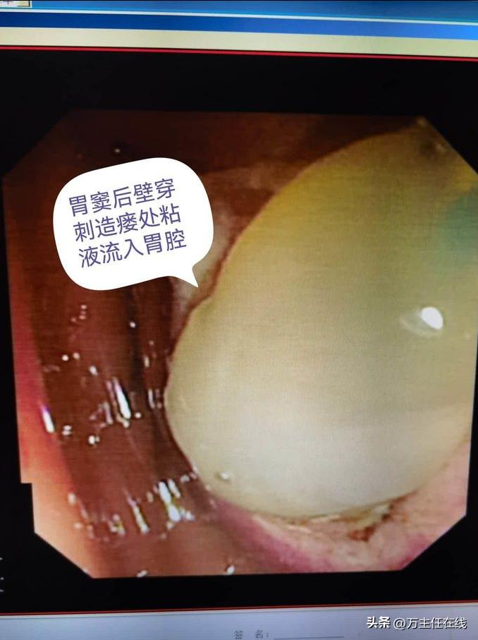 腹腔粘液癌治疗有妙招——万荣教授以内镜Notes技术成功胃减压