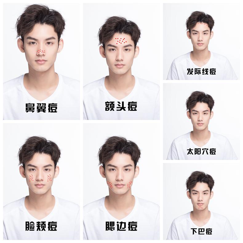 祛痘攻略图文,全网最好用的祛痘方法