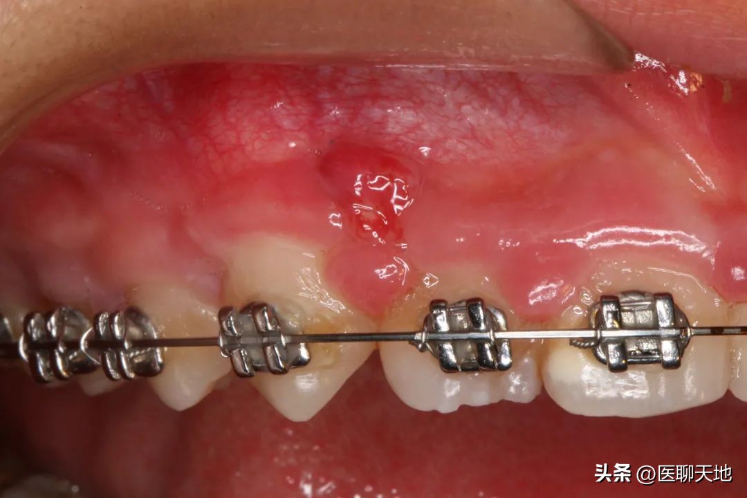 正畸前必须治疗牙周吗,牙周病患者是否能进行正畸治疗