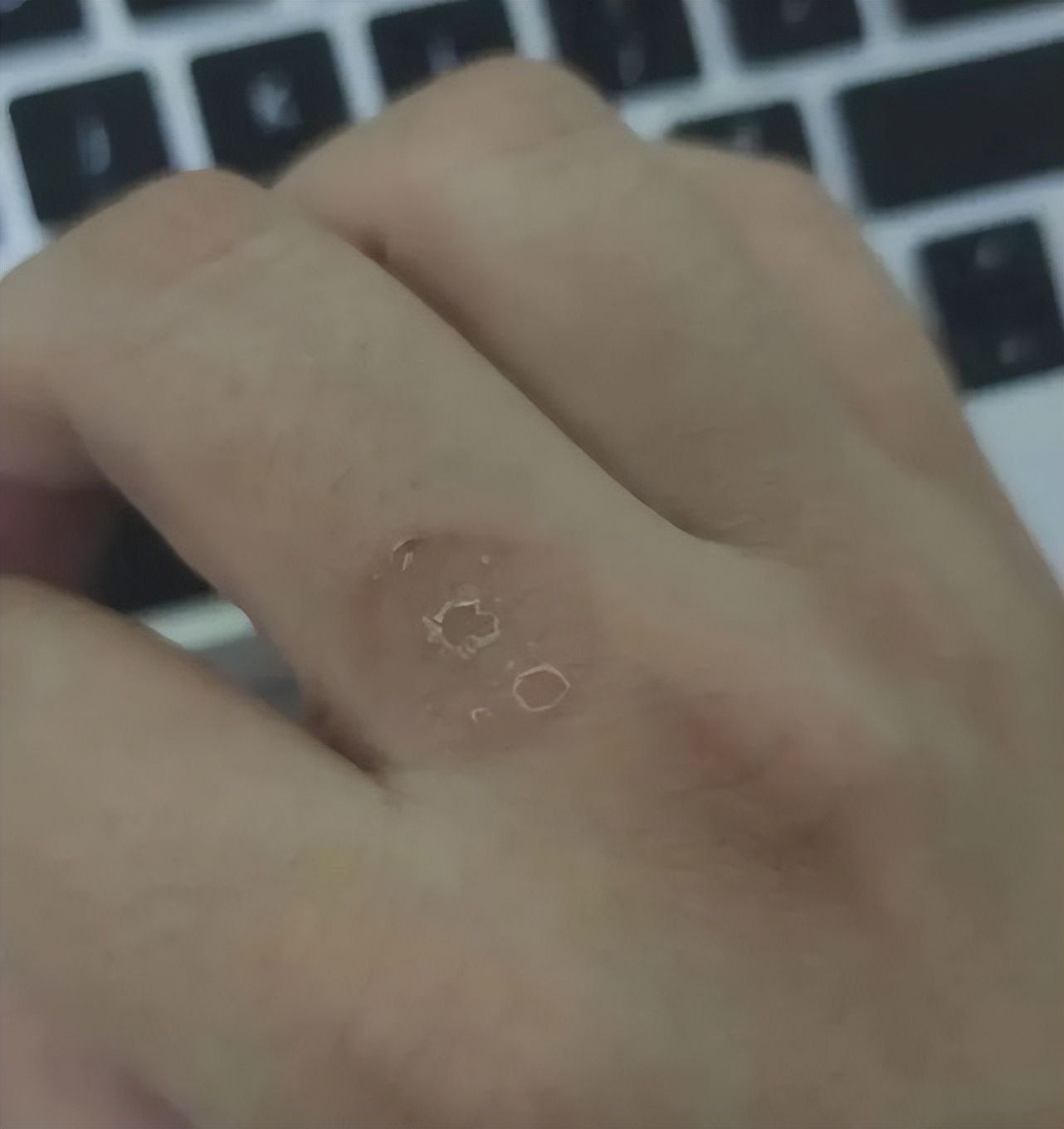 猫咪得猫癣人怎么办,猫咪得了猫癣人怎么办