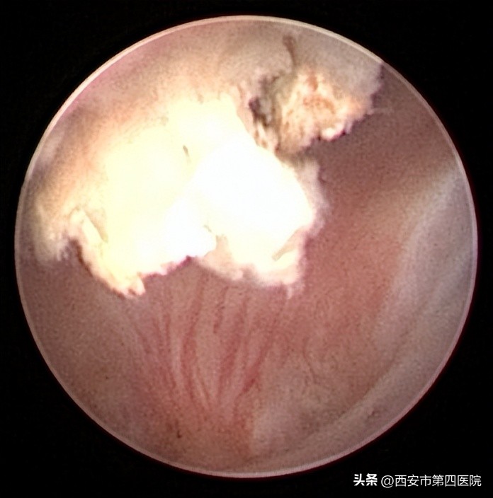 #健康中国行动2030#不明原因尿血7个月，一条热搜治好了她的病