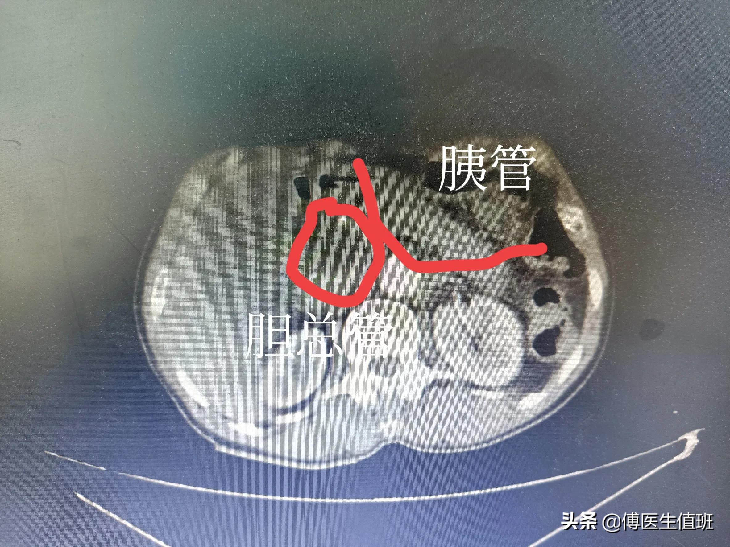 男子吃鸡后腹胀、腹泻，医院检查发现转氨酶升高，医生：胰腺肿瘤