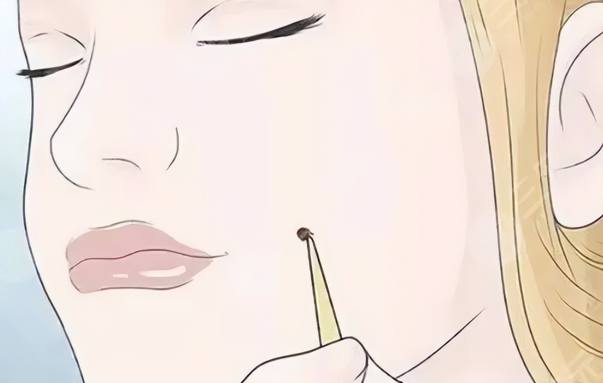 长毛痣怎么治最有效果,嘴角痣长毛凸起能点吗