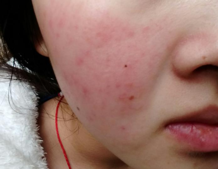 用了护肤品皮肤刺痛是缺水吗,护肤刺痛缺水怎么回事