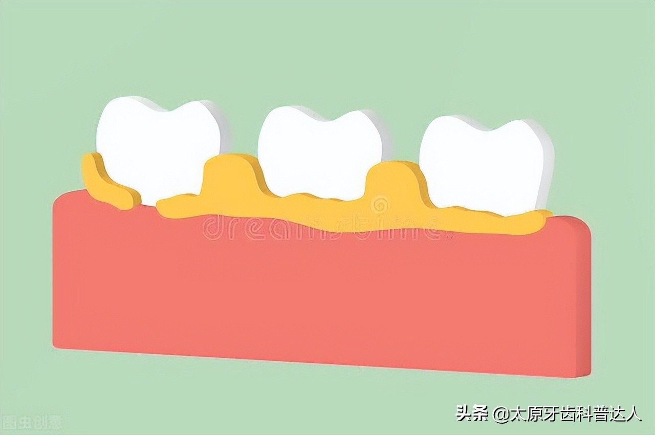 洗牙可以预防口臭嘛,洗牙可以预防什么病