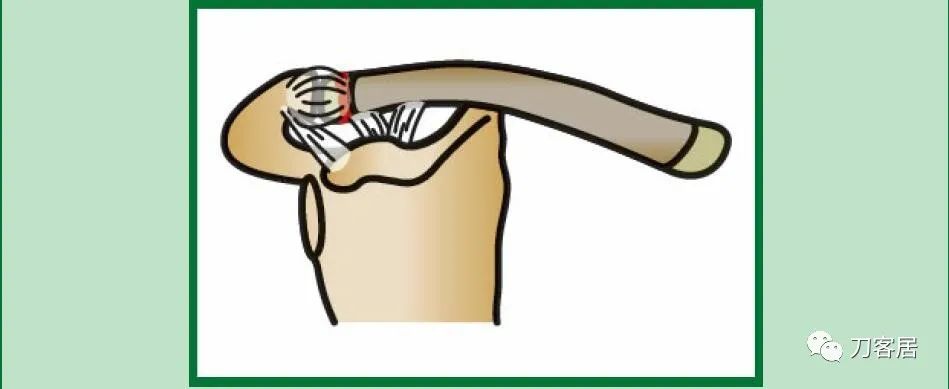 儿童锁骨骨折保守治疗的弊端,锁骨粉碎骨折错位不处理会愈合吗