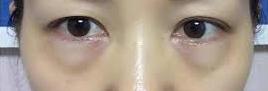 卧蚕眼袋大最简单的去眼袋的方法,消除眼袋方法多勿把卧蚕当眼袋