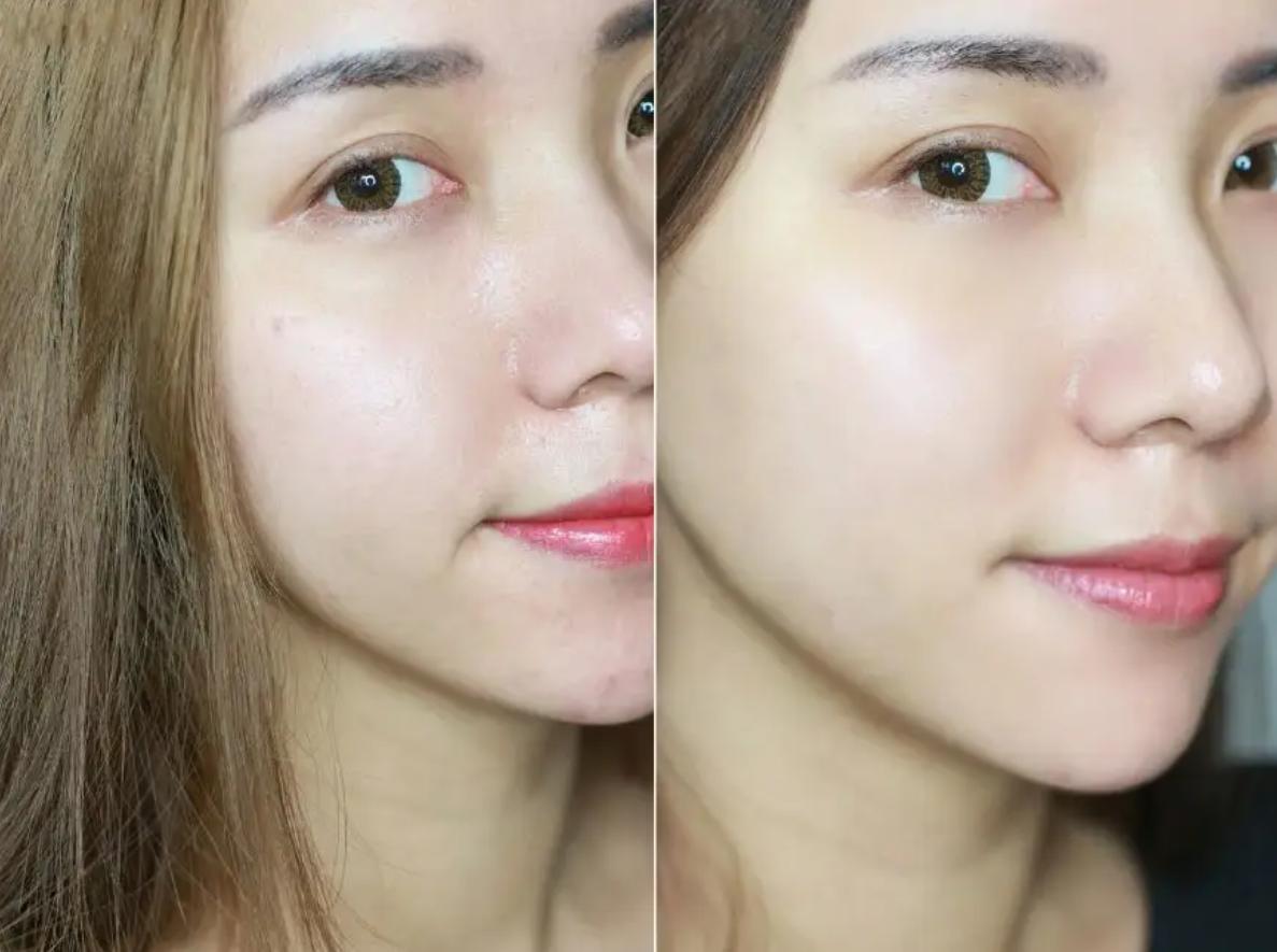 痘痘的种类图及解决办法,痘痘分阶段处理