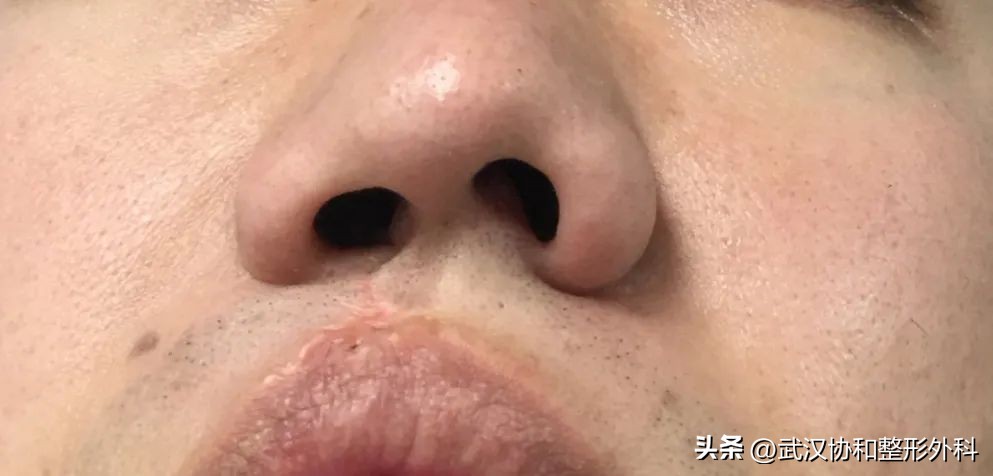 唇腭裂做一次手术就好了吗,唇腭裂一次性做完鼻子好吗