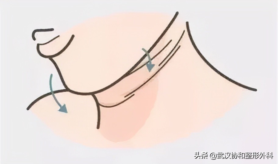 出现颈纹有没有什么好办法去,刮颈部能去除颈纹吗