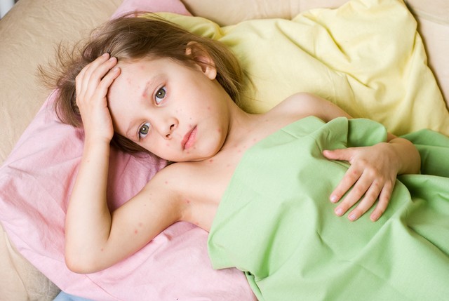 麻疹会引起疼痛么,荨麻疹得了很痛苦吗