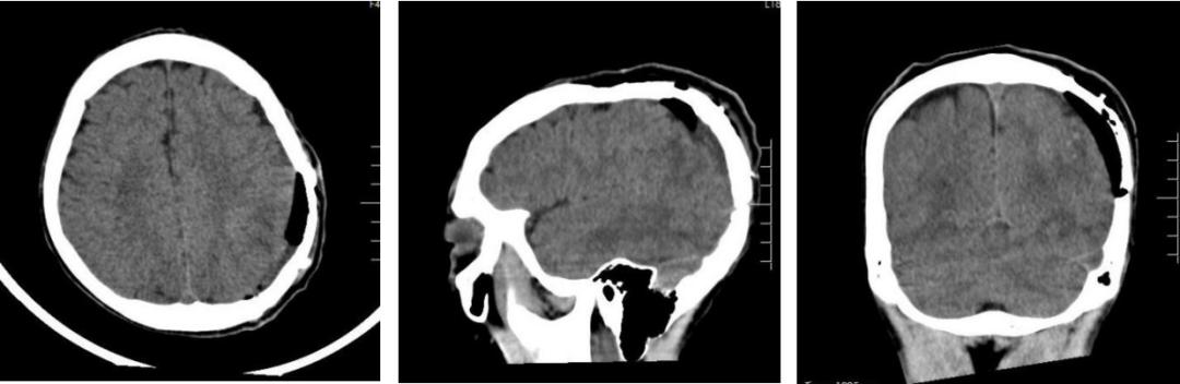 飞来横祸，初中生脑袋被铅球砸出一个“坑”