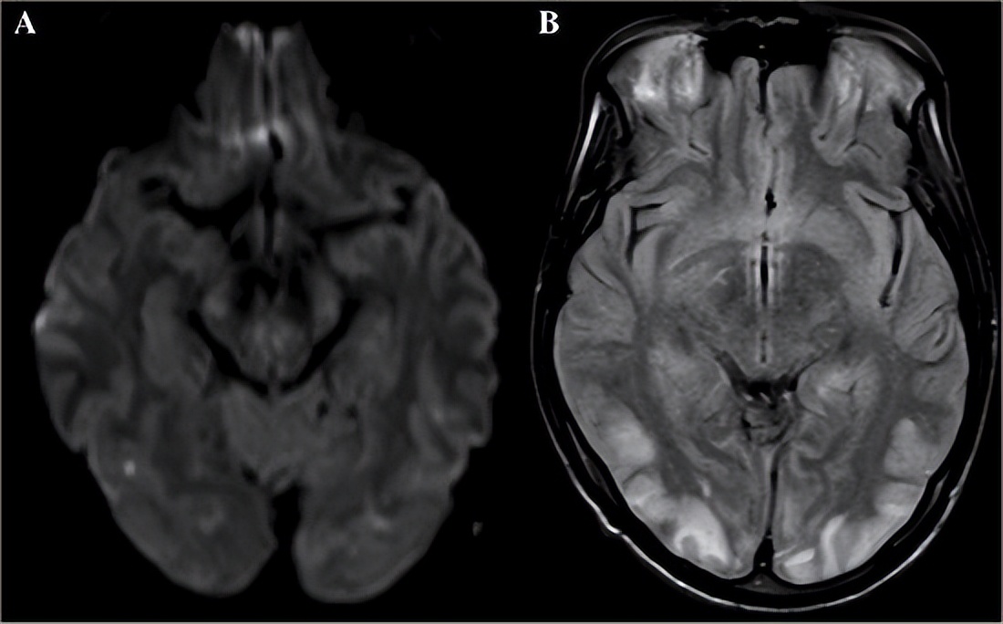 手部麻木怎么办,手部麻木吃什么药好