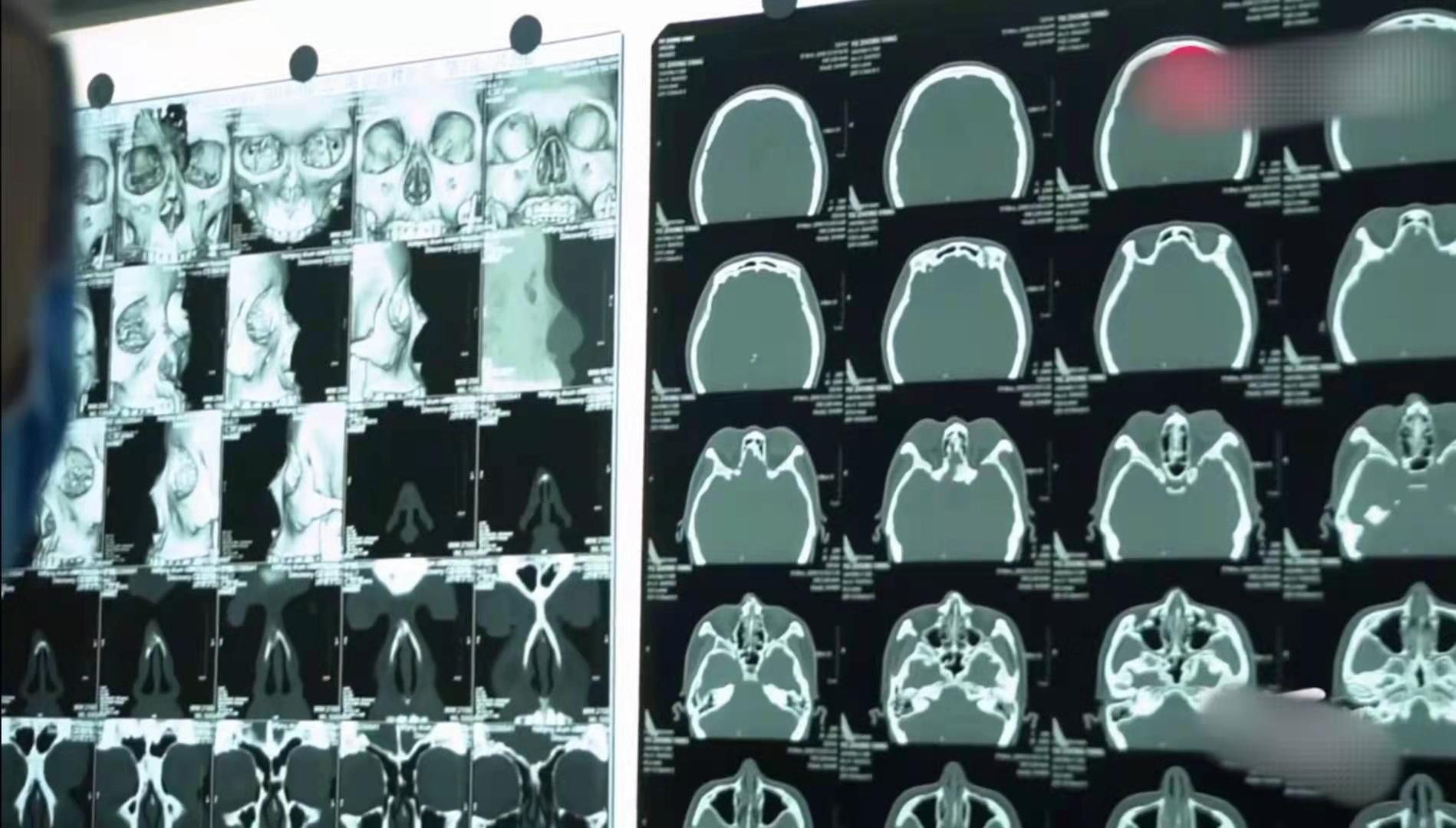 鼻子里长肿瘤的女孩儿,女子鼻子上长肿瘤