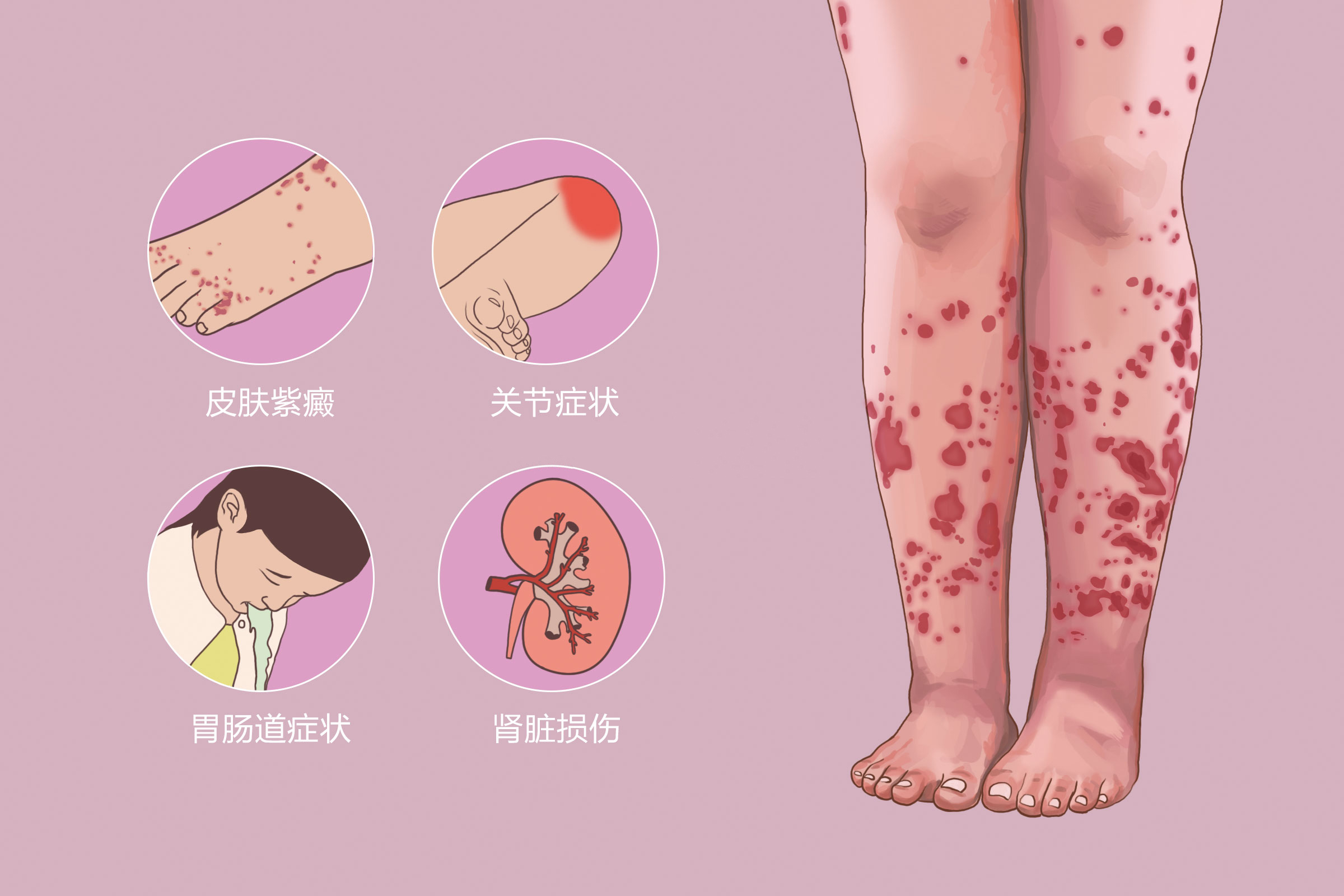 过敏性紫癜属于皮肤病吗,和过敏性紫癜相似的皮肤病