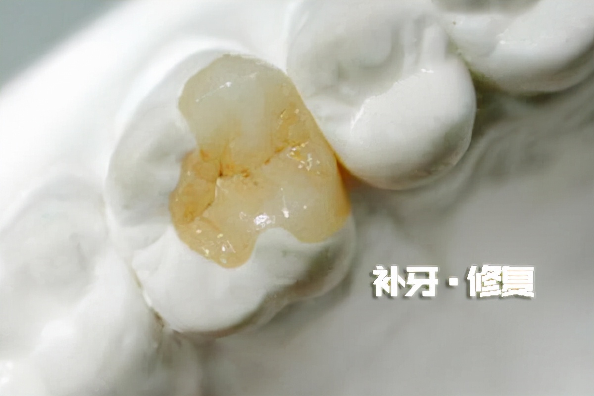 补牙几百对方要三千合理吗,同样是补牙为什么效果不一样