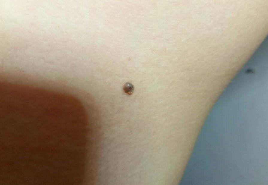 长在身体什么部位的痣容易癌变,脖子突然长痣是癌症的症状