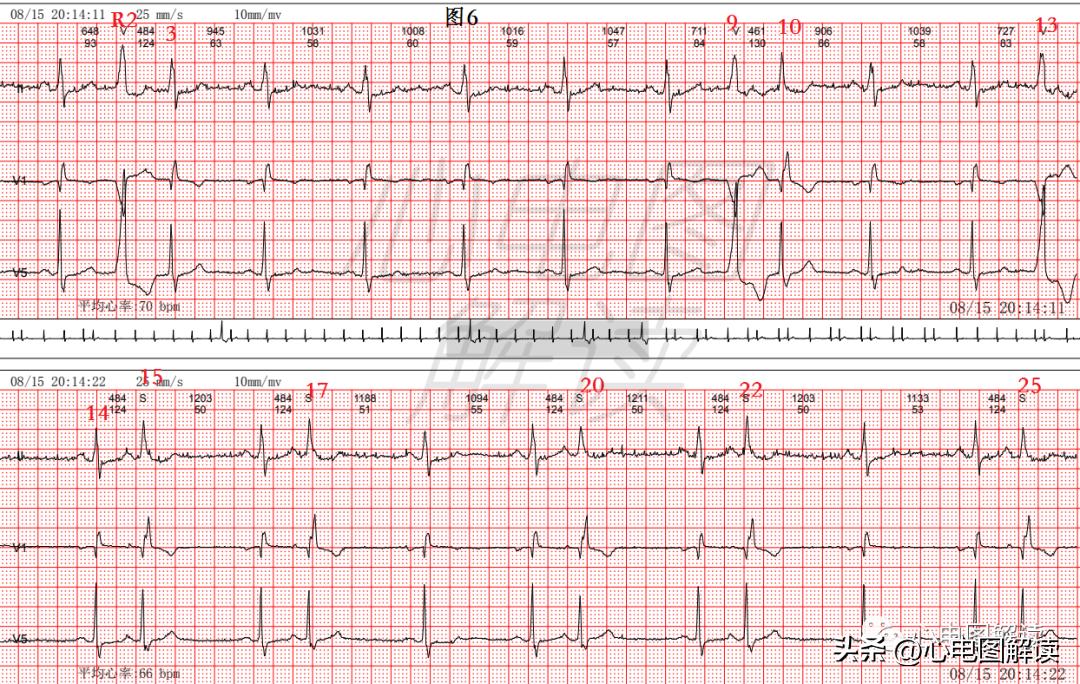 房早与房室交界性早搏心电图鉴别,偶发室早与阵发室早的区别